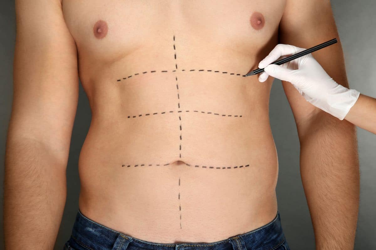 abdominoplastie