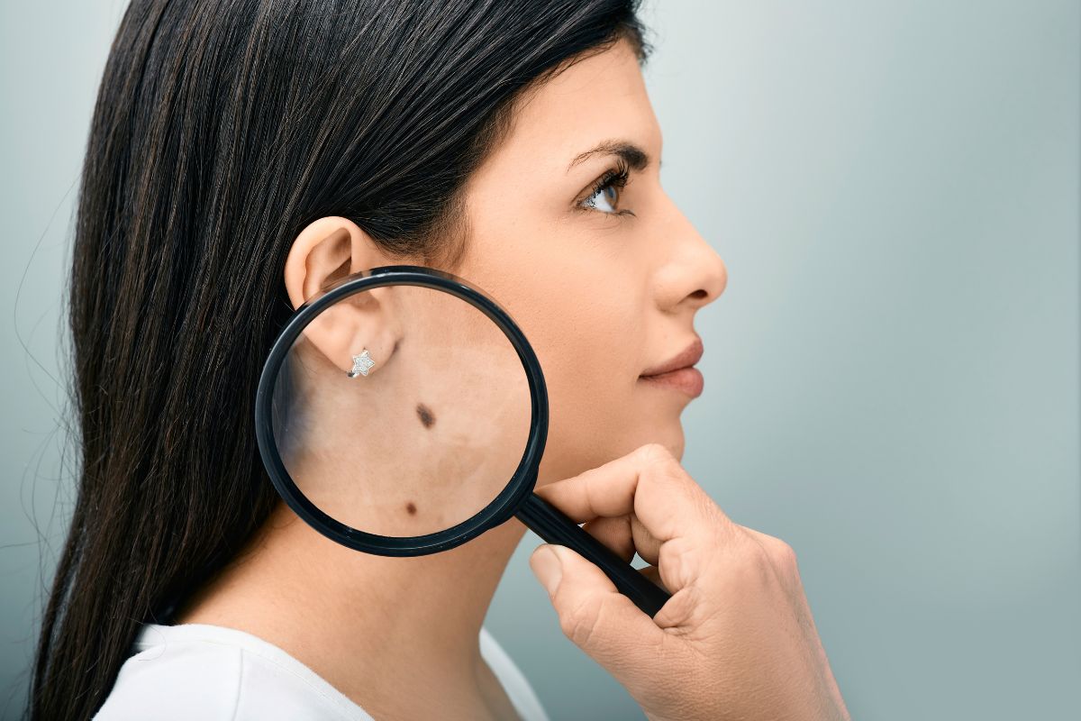 Comment enlever un grain de beauté naturellement